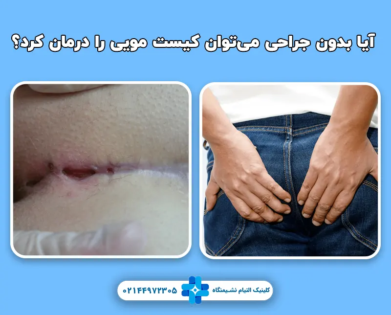 آیا بدون جراحی می‌توان کیست مویی را درمان کرد؟