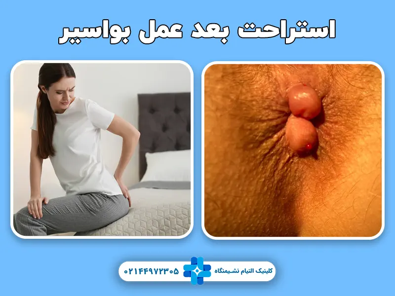 استراحت بعد عمل بواسیر