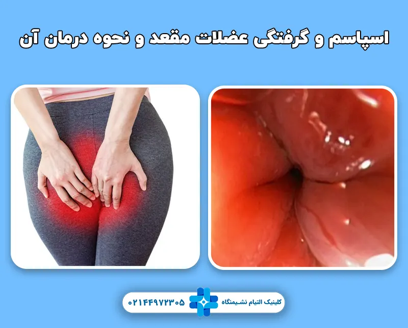 اسپاسم و گرفتگی عضلات مقعد و نحوه درمان آن