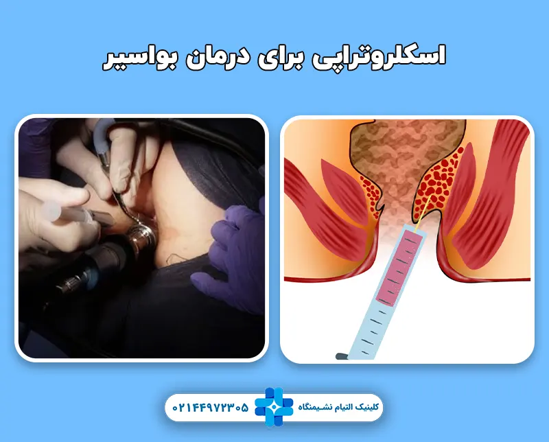 اسکلروتراپی برای درمان بواسیر