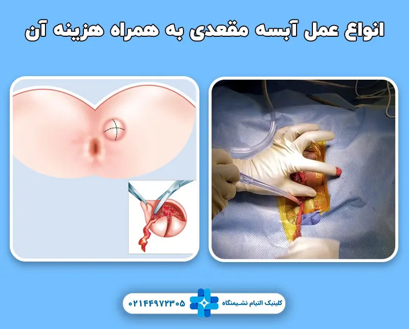 عمل آبسه مقعدی