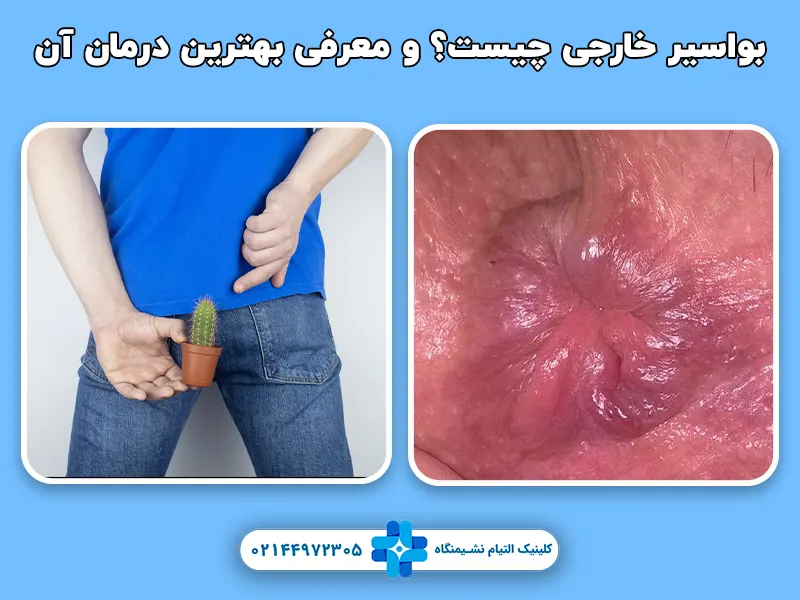 بواسیر خارجی چیست؟ و معرفی بهترین درمان آن