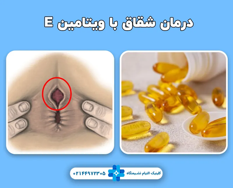 نحوه درمان شقاق با کپسول ویتامین E