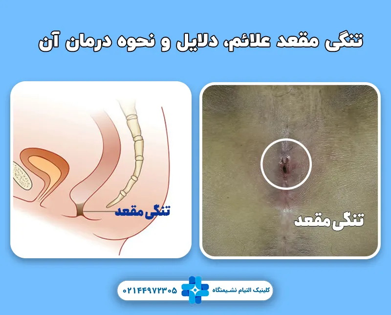 علت تنگی مقعد و نحوه درمان آن