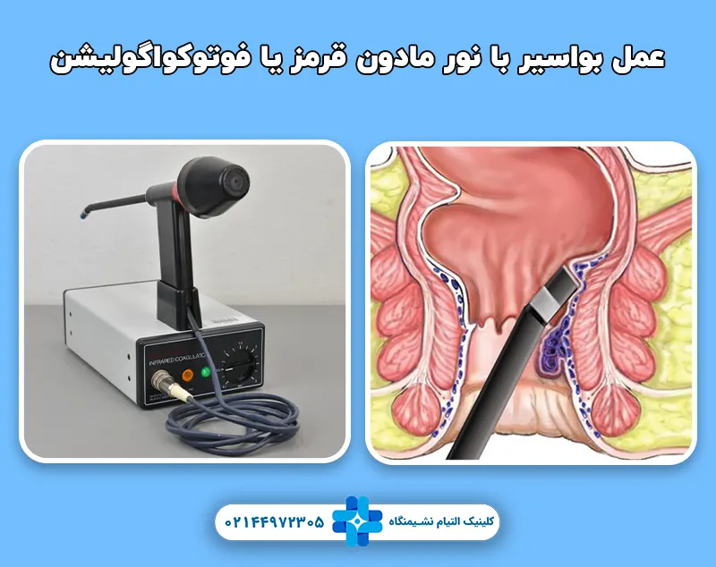 عمل بواسیر با نور مادون قرمز یا فوتوکواگولیشن