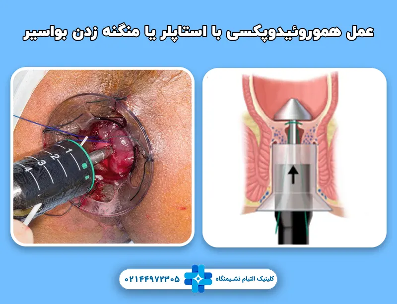 عمل هموروئیدوپکسی با استاپلر یا منگنه زدن بواسیر