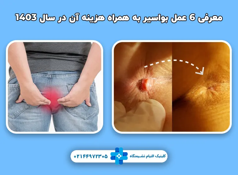 معرفی 6 عمل بواسیر به همراه هزینه آن در سال 1403
