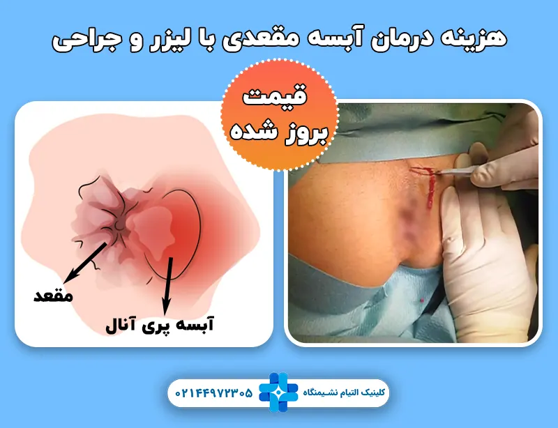 هزینه درمان آبسه مقعدی با لیزر