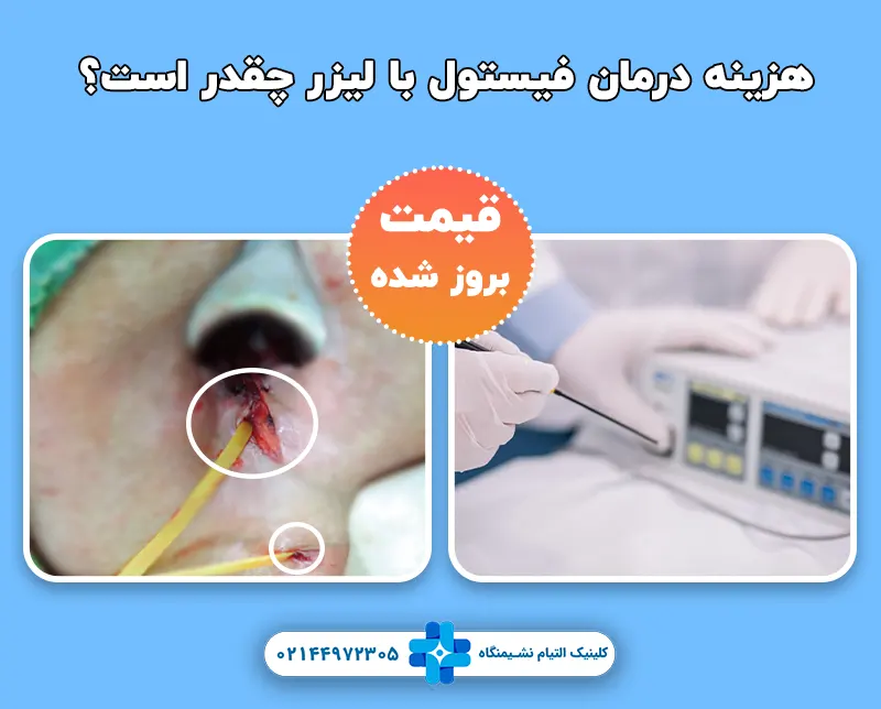 هزینه درمان فیستول با لیزر