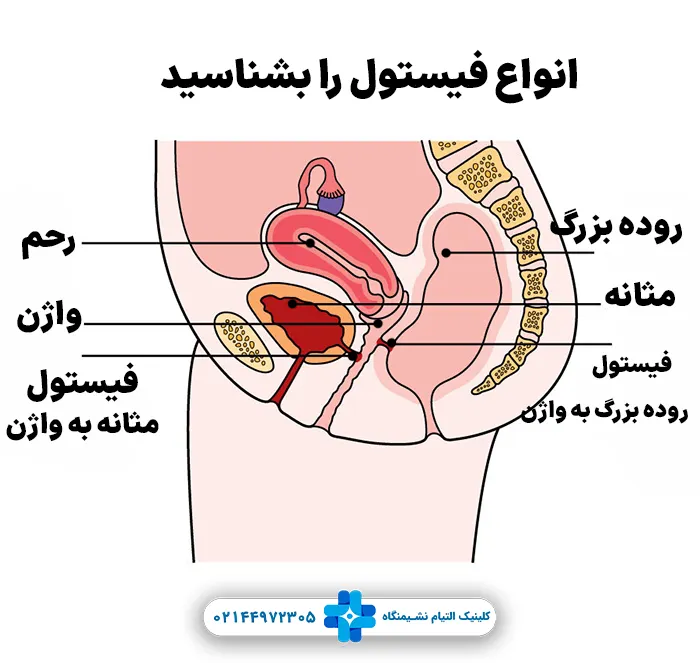 انواع فیستول