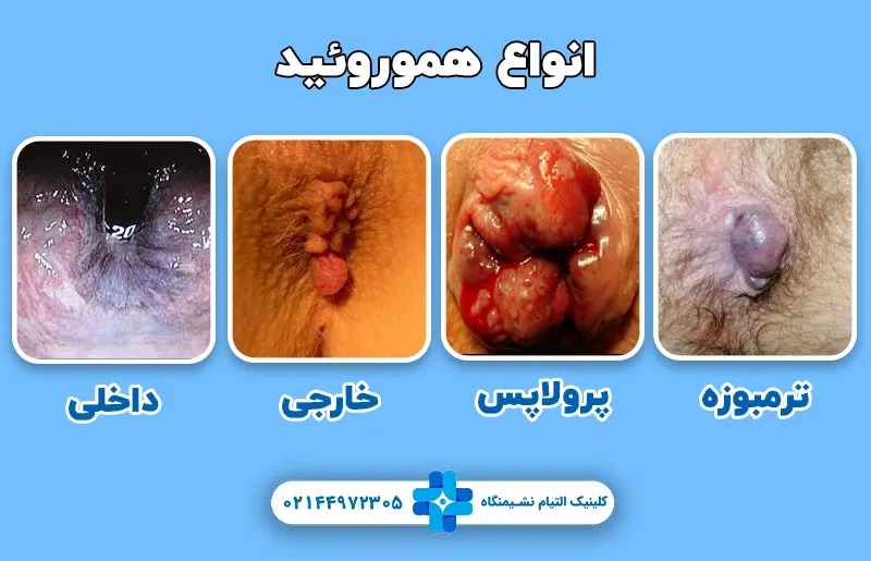 انواع هموروئید