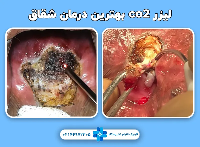 بهترین درمان شقاق