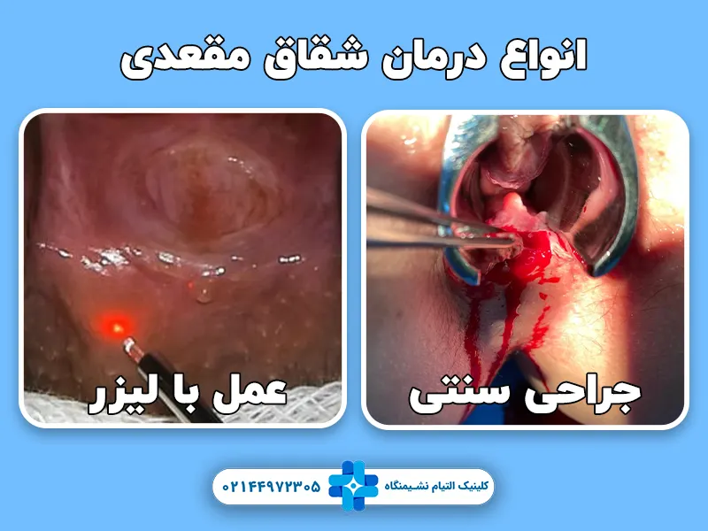 جراحی زخم مقعدی