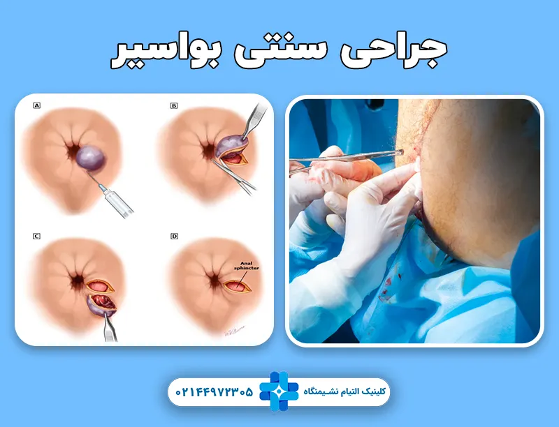 جراحی سنتی بواسیر