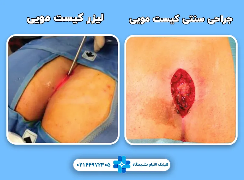 تفاوت درمان لیزری و سنتی کیست مویی