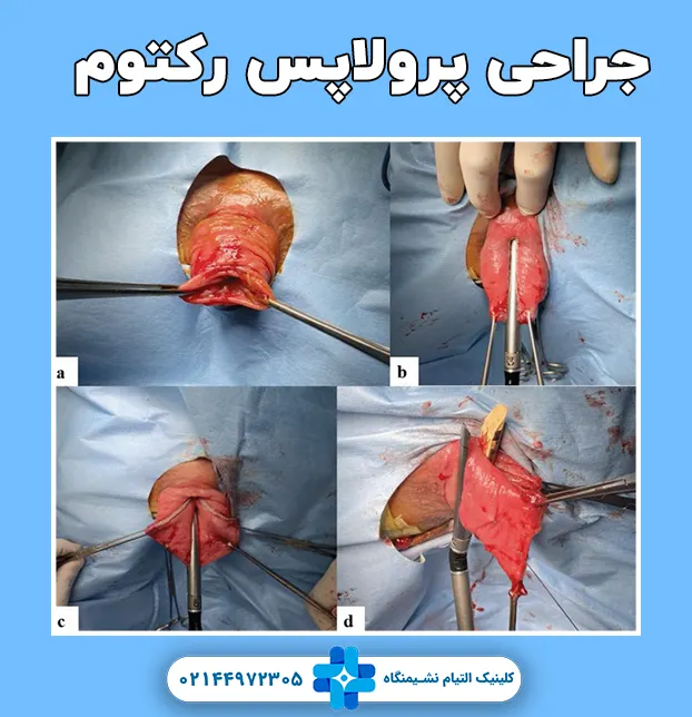 جراحی پرولاپس رکتوم