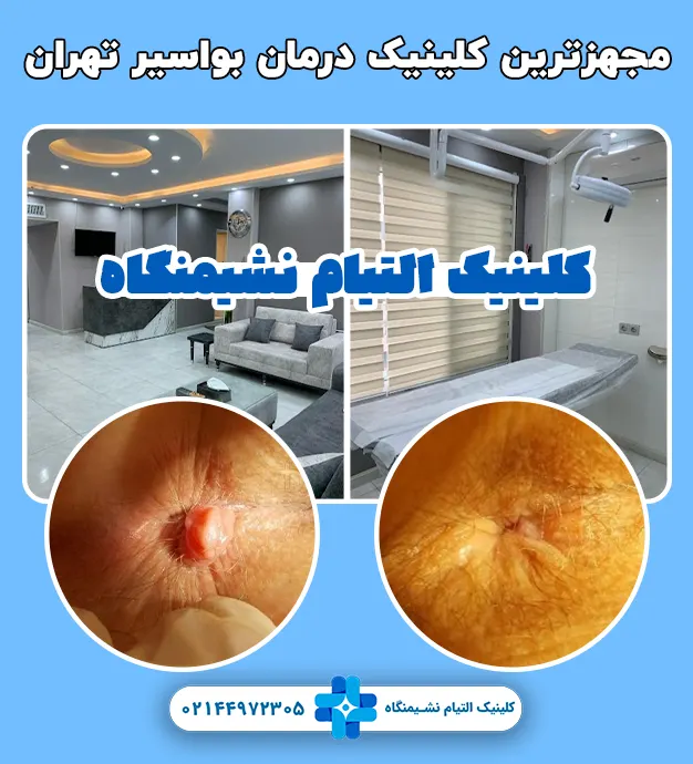 درمان بواسیر با لیزر تهران