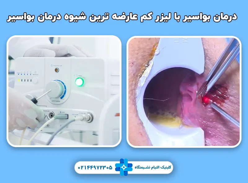 درمان بواسیر با لیزر