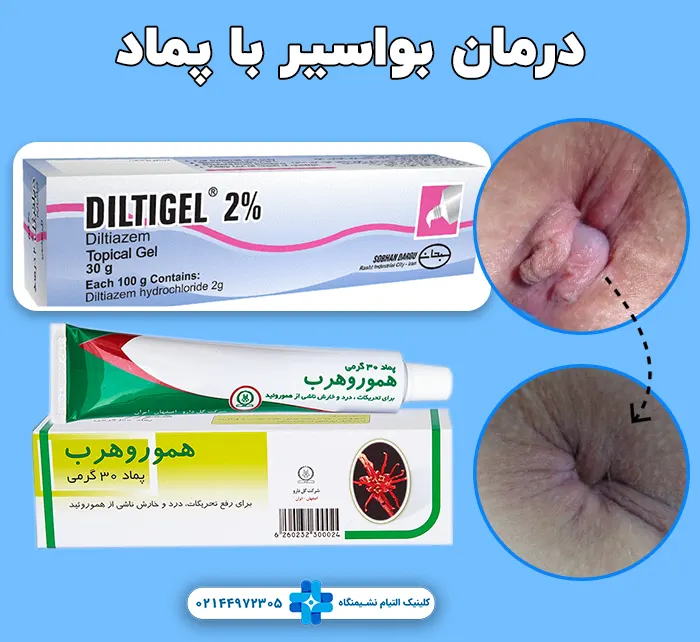 درمان بواسیر با پماد