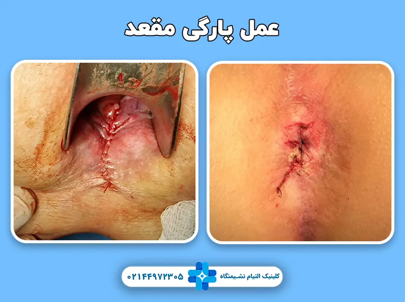 عمل پارگی مقعد