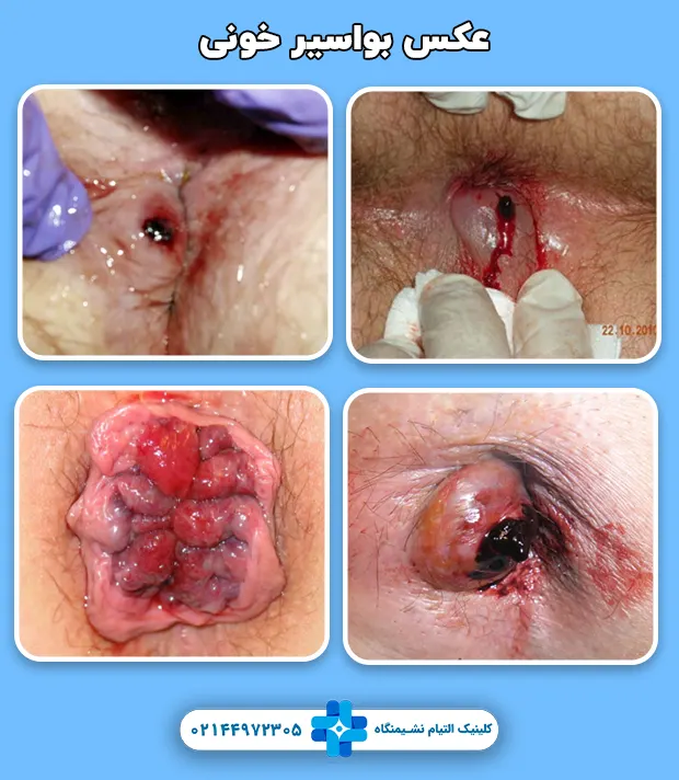 عکس بواسیر خونی