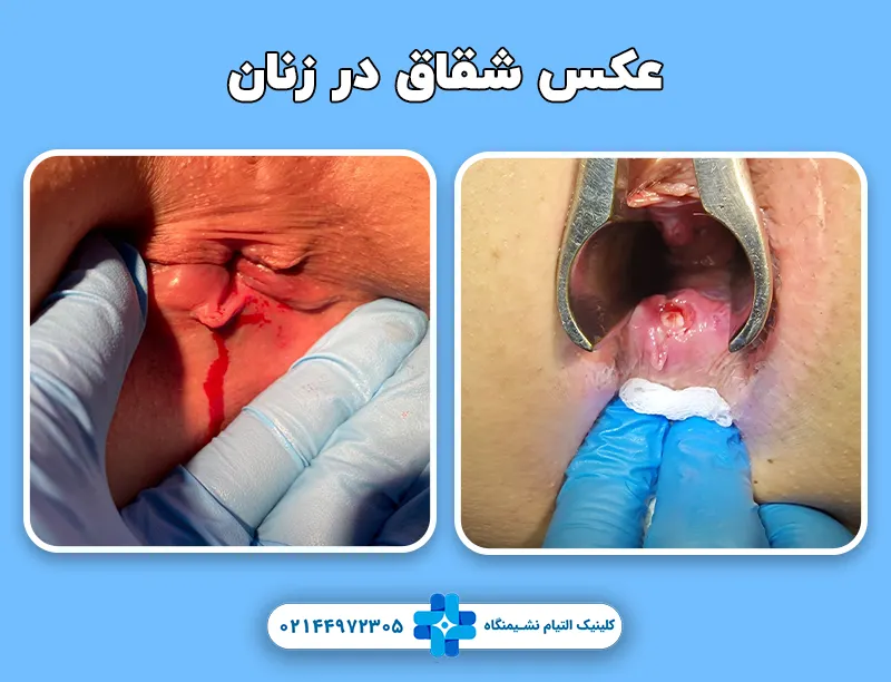 عکس شقاق مقعد در زنان