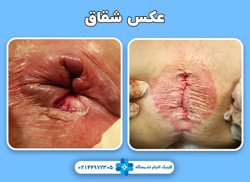 عکس شقاق مقعدی