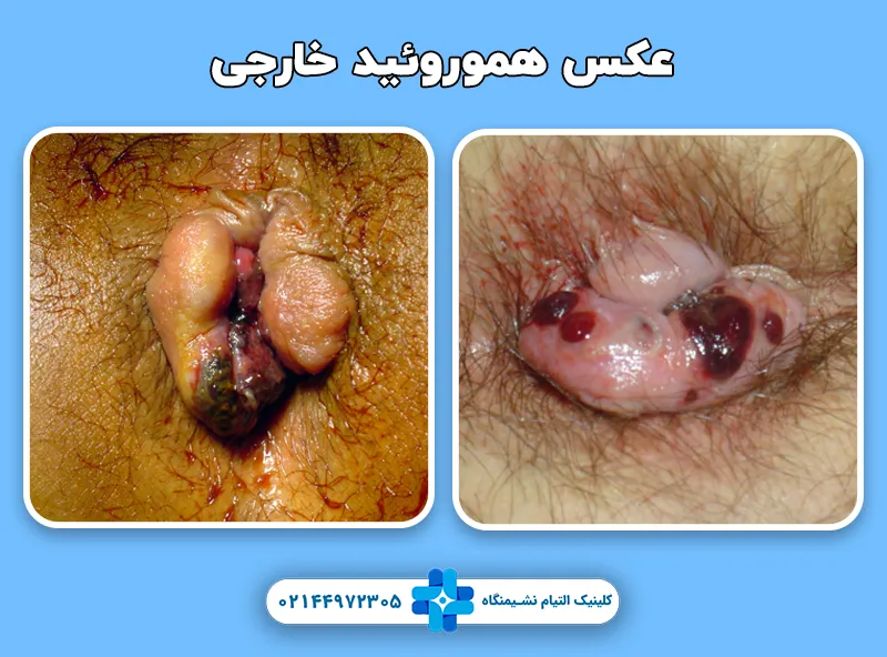 عکس هموروئید