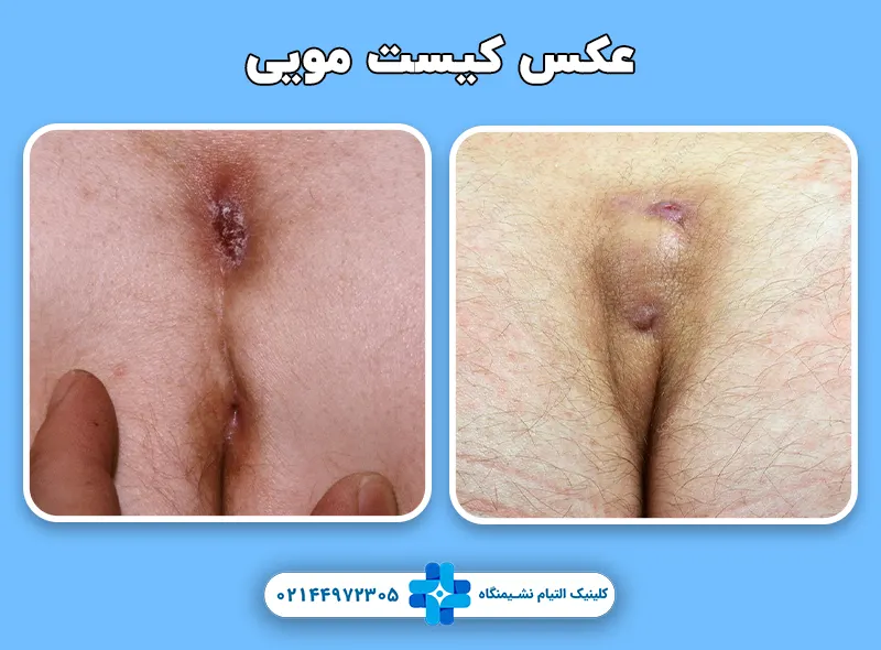 عکس کیست مویی