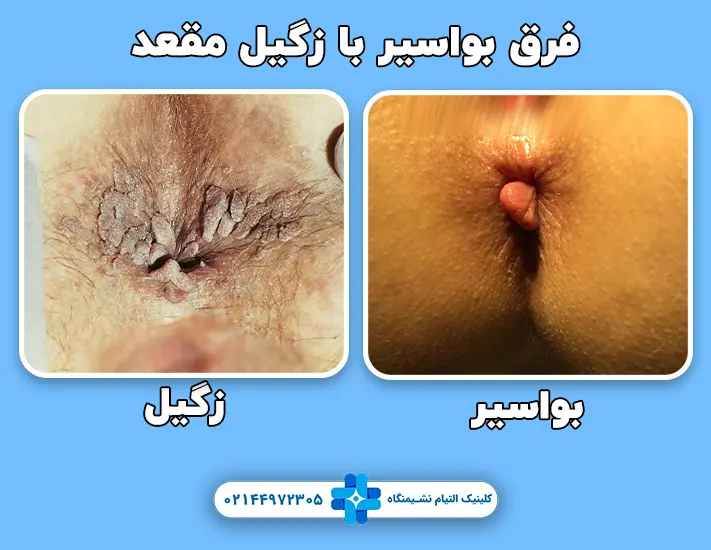 فرق بواسیر و زگیل