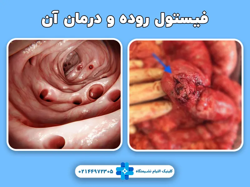 فیستول روده