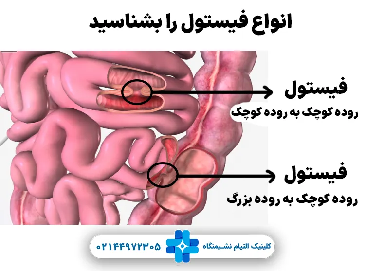فیستول روده کوچک