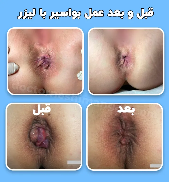 قبل و بعد لیزر بواسیر