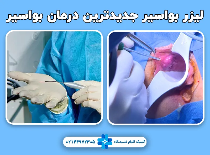 لیزر بواسیر