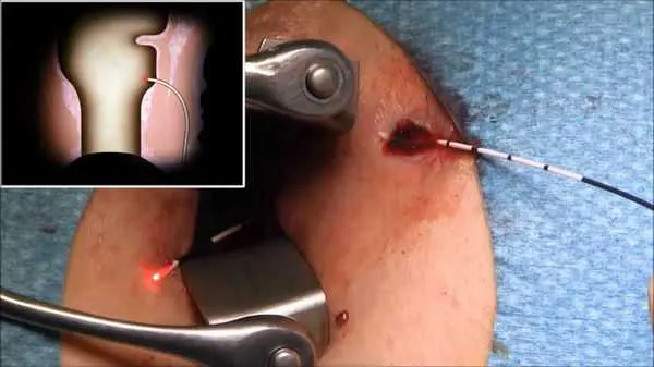 لیزر فیستول