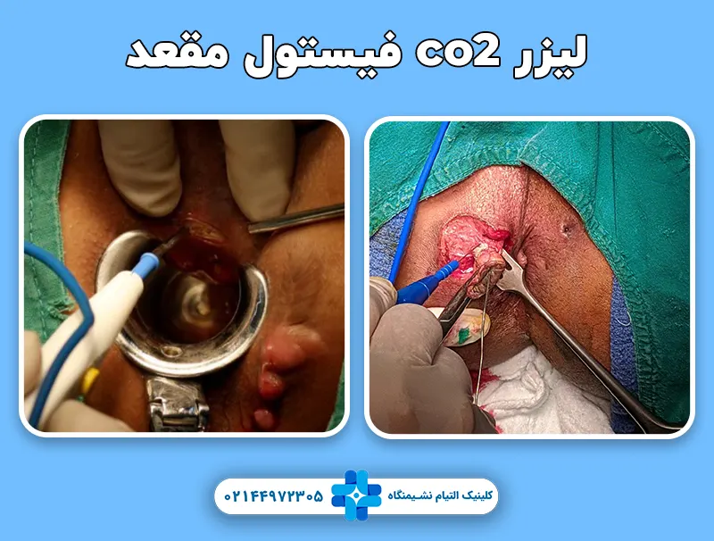 لیزر co2 فیستول