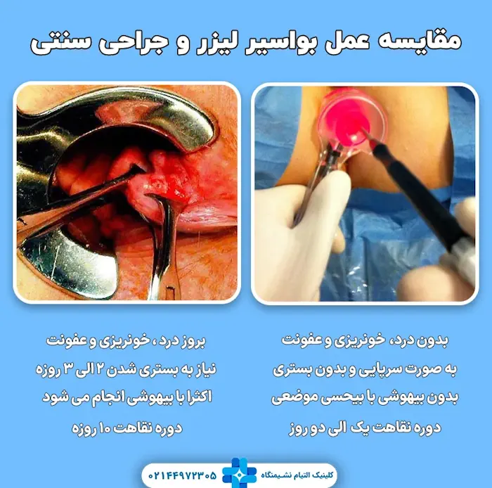 مقایسه عمل بواسیر لیزر و جراحی