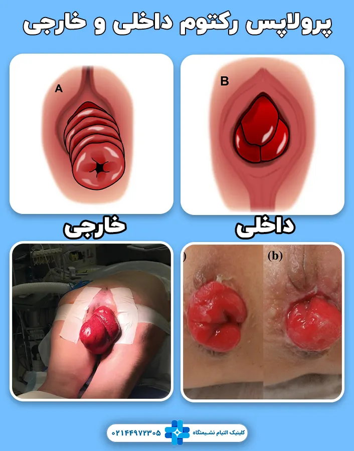 پرولاپس رکتوم