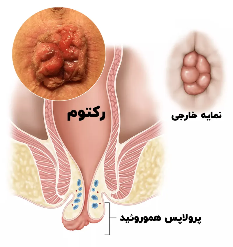 پرولاپس هموروئید چیست؟