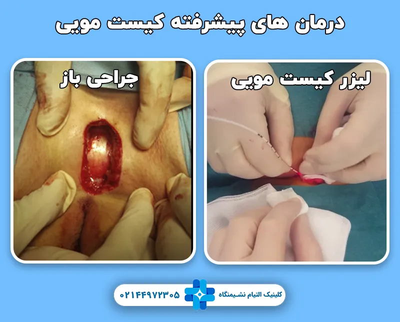 درمان کیست مویی