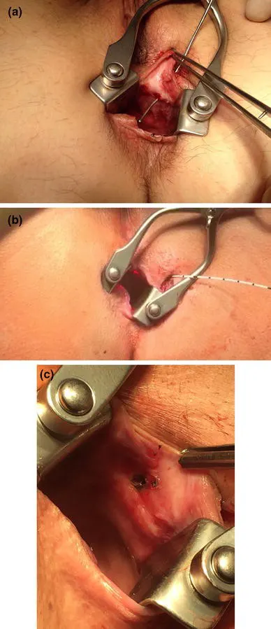 درمان فیستول با لیزر