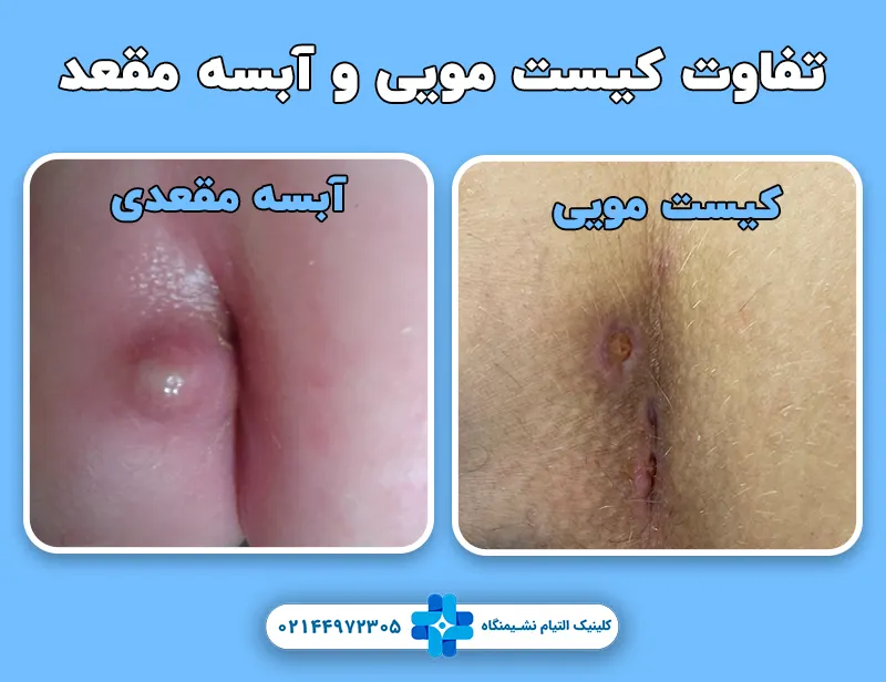 تفاوت کیست مویی و آبسه مقعد