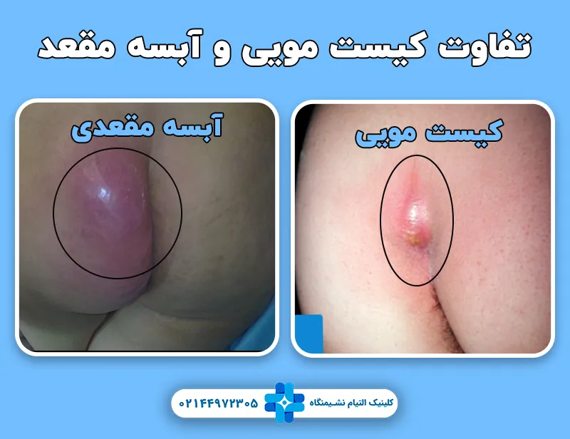 تفاوت کیست مویی و آبسه مقعد