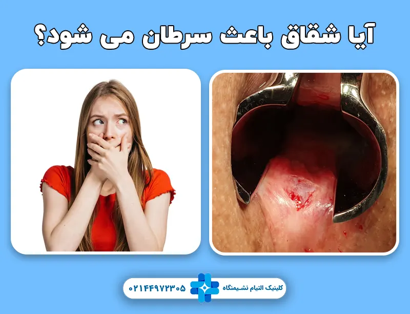 آیا شقاق باعث سرطان مقعد می شود؟