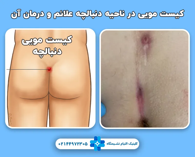 کیست مویی در ناحیه دنبالچه علائم و درمان آن