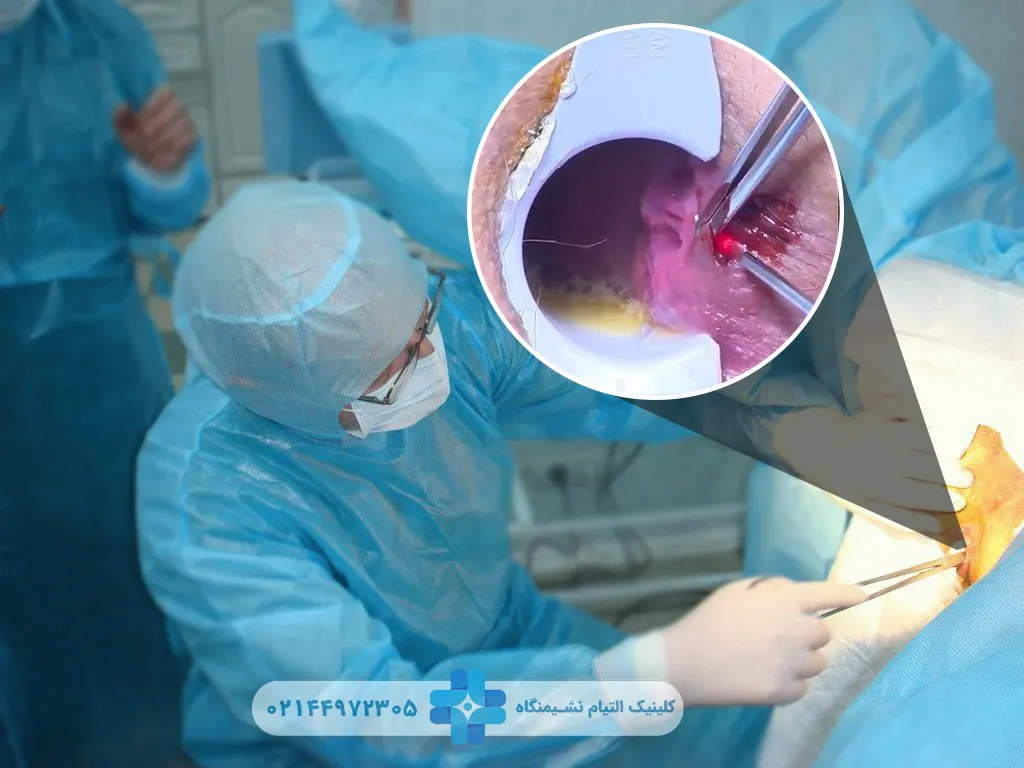 لیزر بواسیر