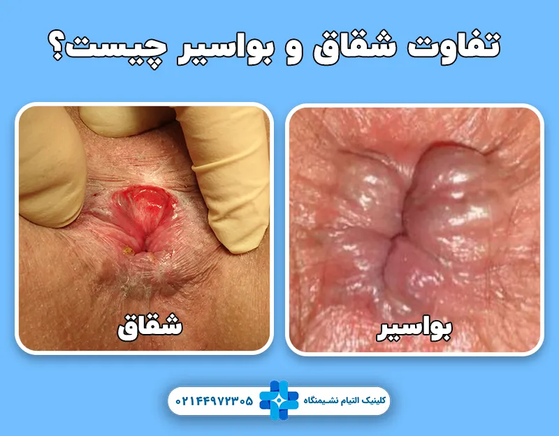 تفاوت شقاق و بواسیر