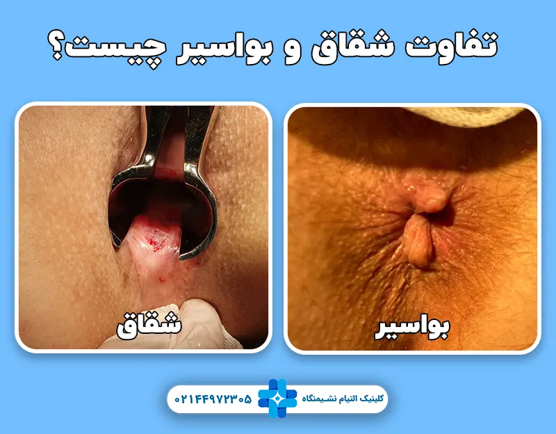 تفاوت شقاق و بواسیر