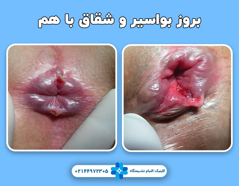 بروز شقاق و بواسیر باهم
