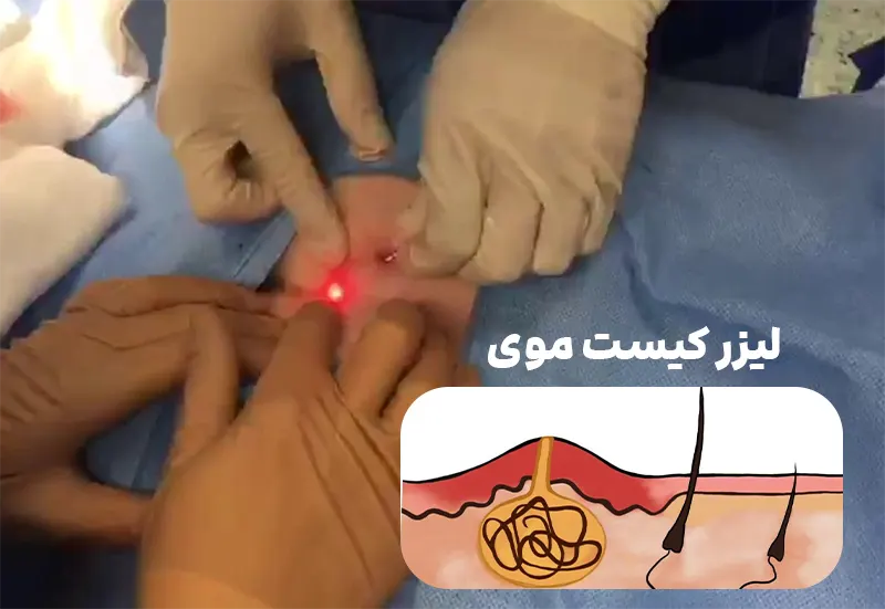 لیزر کیست مویی
